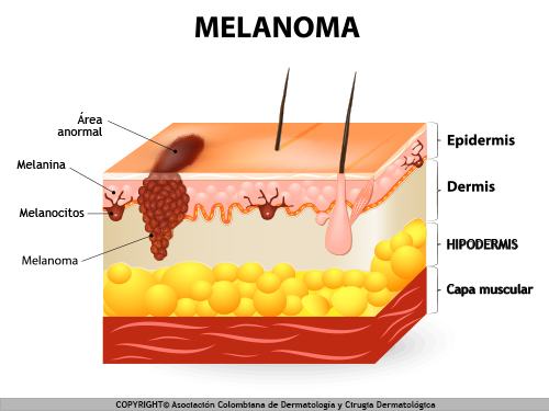 melanoma esquema